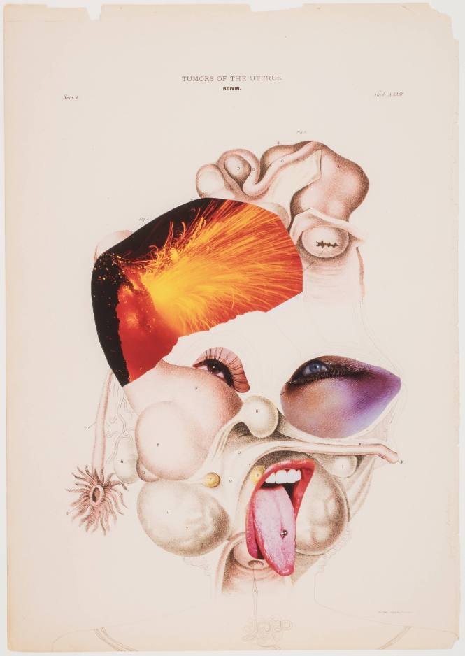 Tumors of the Uterus 