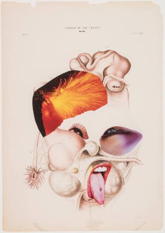 Tumors of the Uterus 