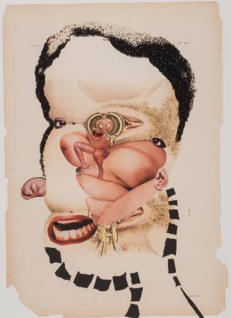 Indurated Chancre of the Cervix